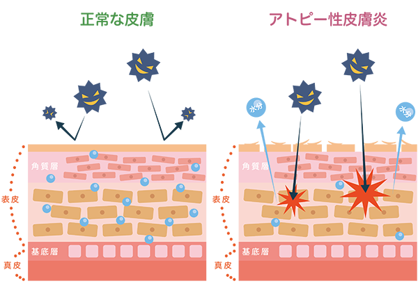 アトピー性皮膚炎の原因について図解でわかりやすく紹介します