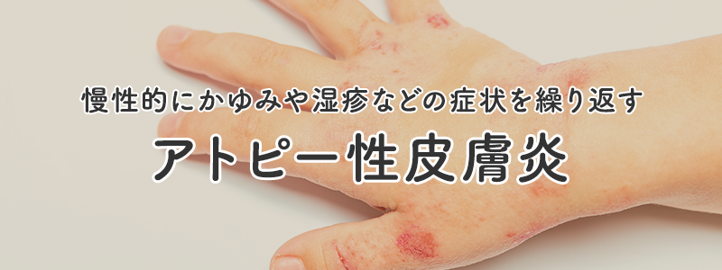慢性的にかゆみや湿疹などの症状を繰り返すアトピー性皮膚炎について詳しく解説します