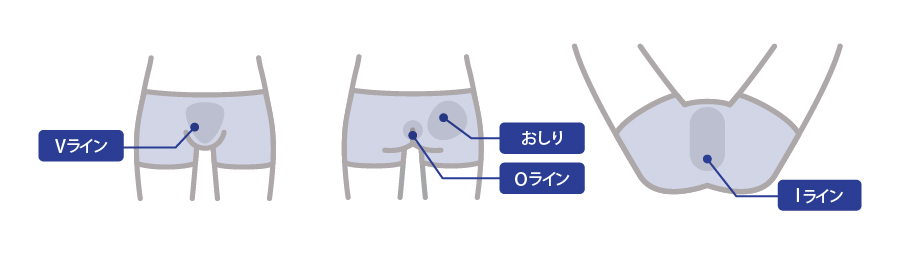 男性の脱毛対象部位 VIO