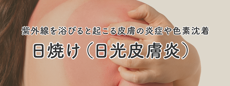 日焼けページのバナー